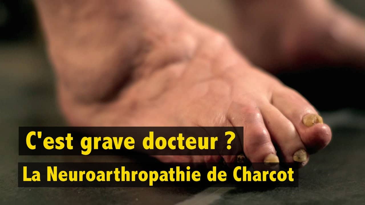 Le pied de Charcot | Diabète 66