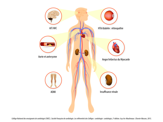 Diabète et Complications cardio-vasculaires