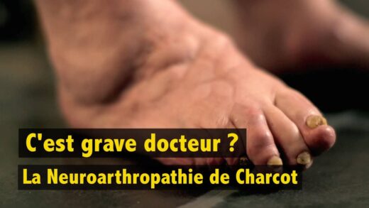 Le pied de Charcot
