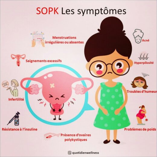 Le syndrome des ovaires polykystiques
