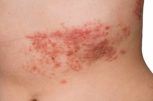 Zona et Diabète : rôle de la vaccination
